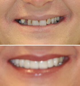 christina-greene-dentistry-before-and-after-photo11