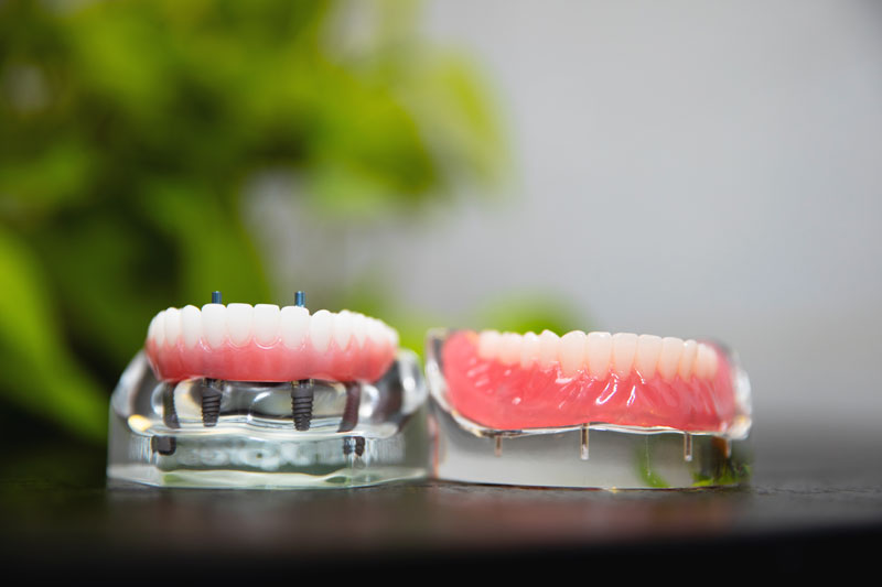 Dental implant model displayed next to a traditional denture, illustrating differences in structure and support.