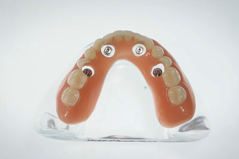 a full arch of teeth with 4 implants holes for placement